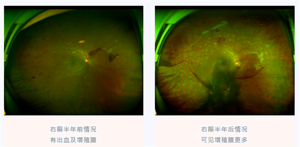 糖尿病视网膜病变