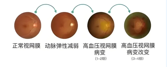 视网膜中央动脉阻塞
