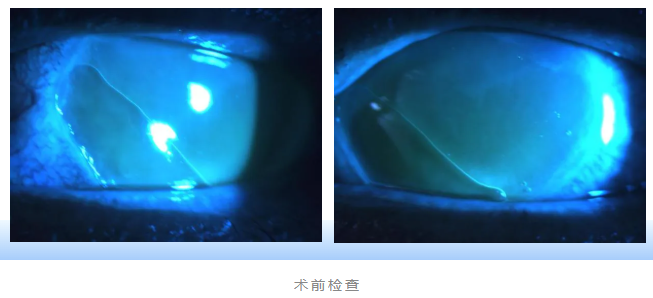 眼外伤