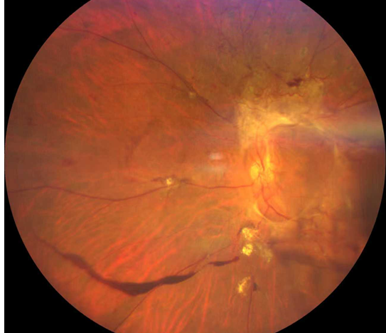 糖尿病视网膜病变