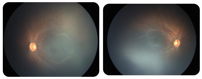 早产儿视网膜病变