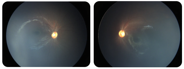 早产儿视网膜病变