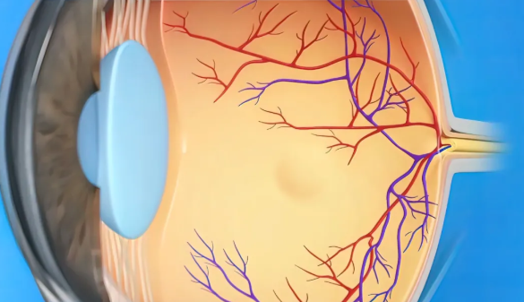 糖尿病视网膜病变
