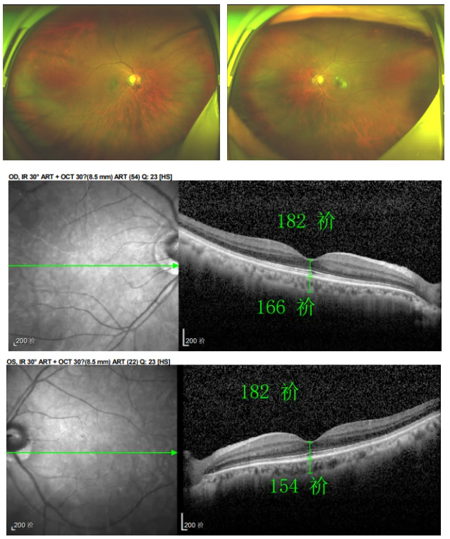 糖尿病视网膜病变