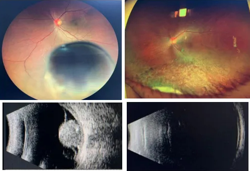 脉络膜黑色素瘤