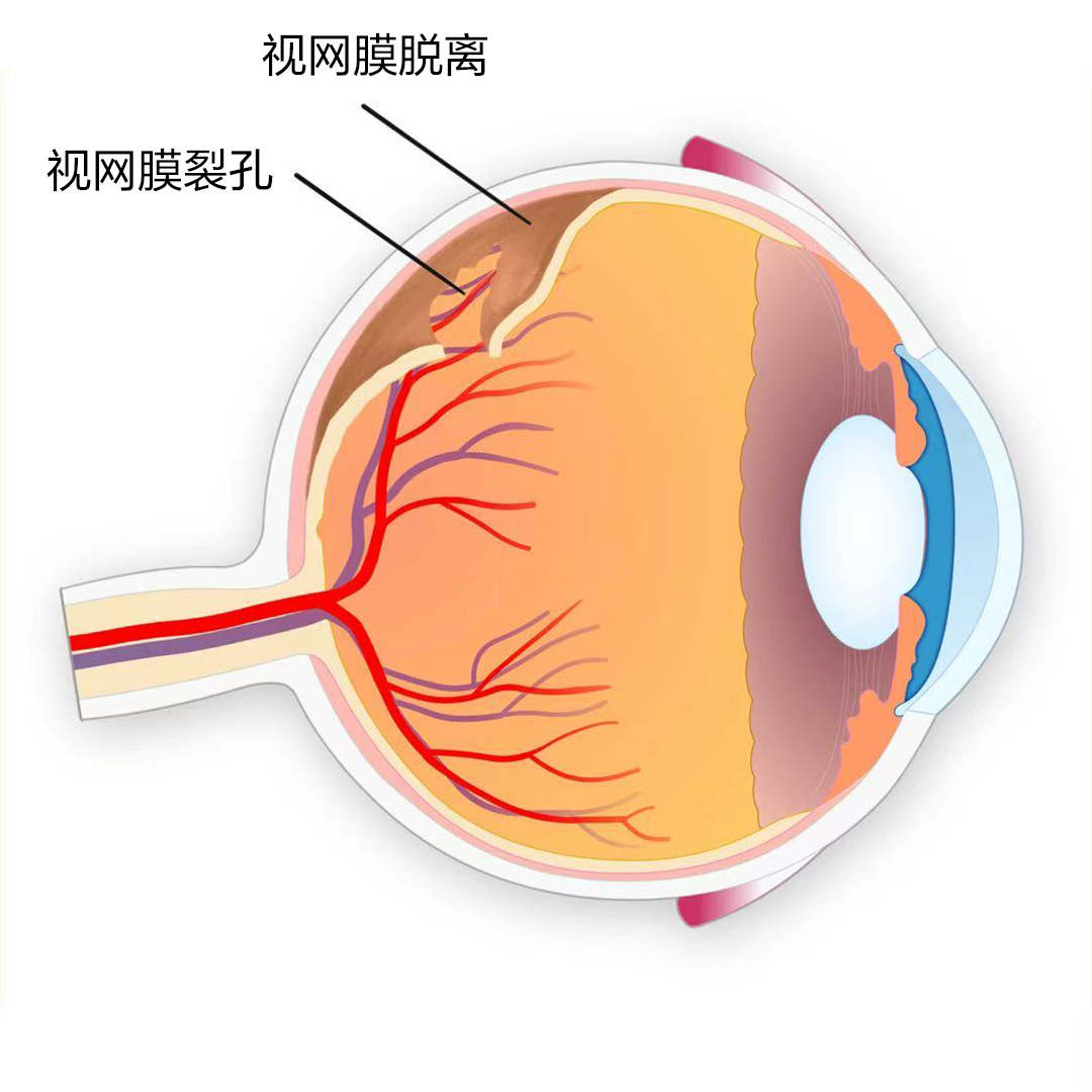 视网膜脱离
