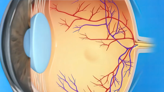 糖尿病视网膜病变